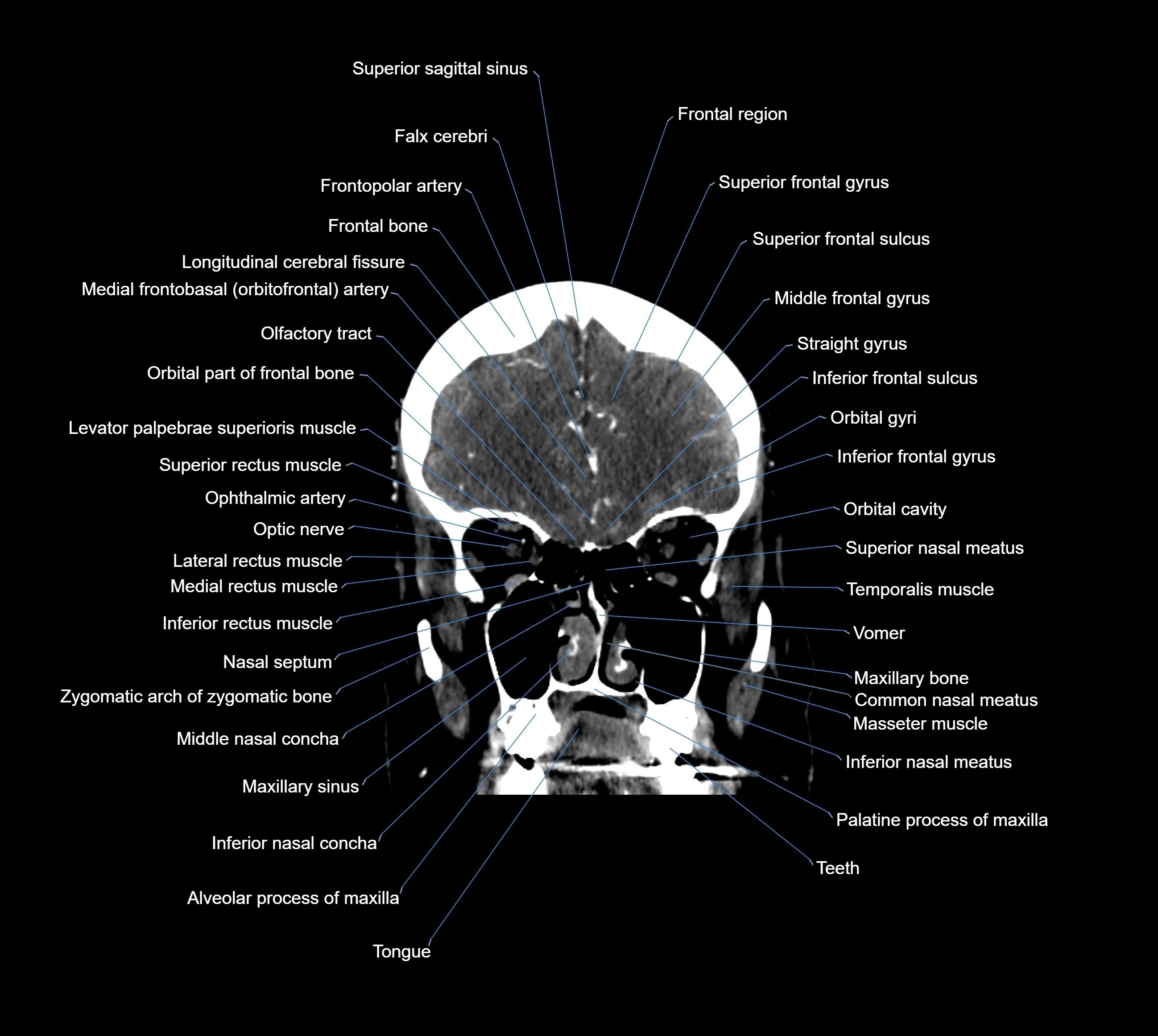 CT Brain coronal cross sectional radiology anatomy image  -img-00001-013.webp